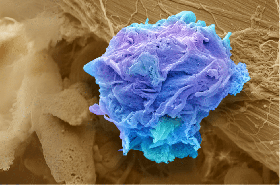 Limfom: kako ga prepoznati, možnosti zdravljenja in obeti za okrevanje