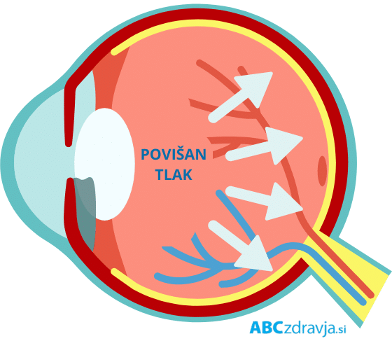 Prikaz povišanega očesnega tlaka pri glavkomu – infografika očesa s puščicami, ki ponazarjajo pritisk v notranjosti očesa kot vzrok za poškodbo vidnega živca.