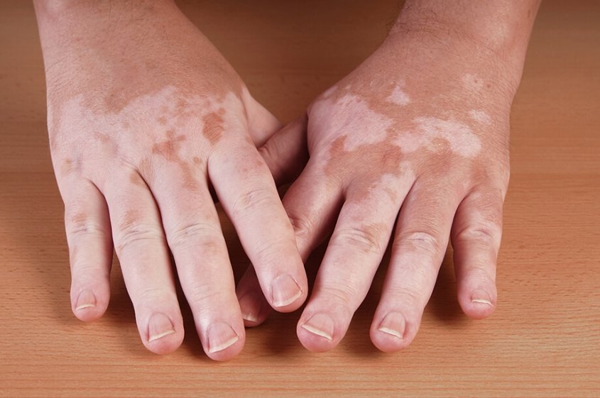 vitiligo