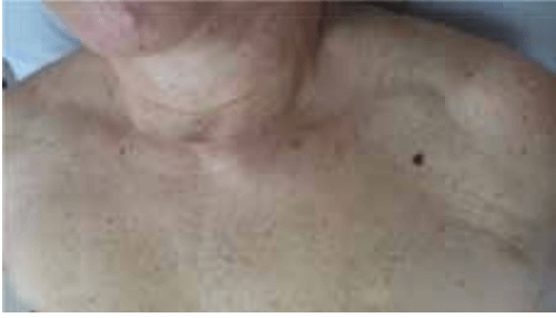 temne lise ali bulice na koži (znamenja) melanom