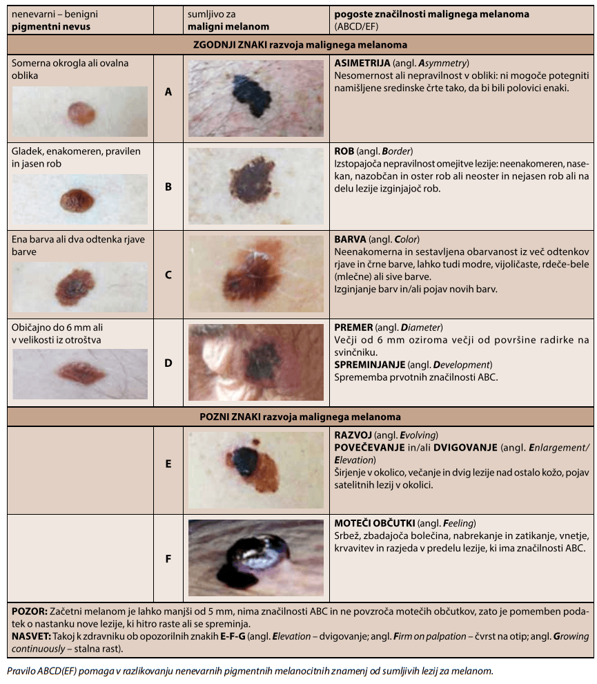 znaki razvoja malignega melanoma