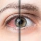 sindrom suhega očesa