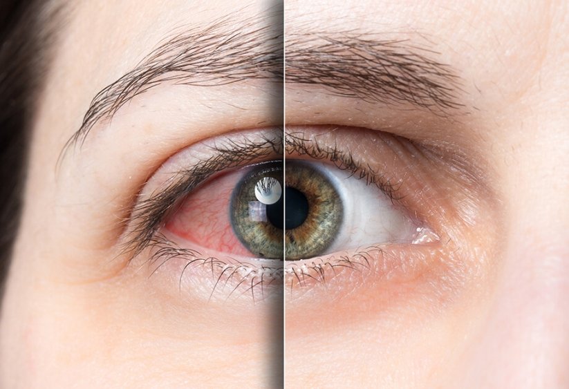sindrom suhega očesa