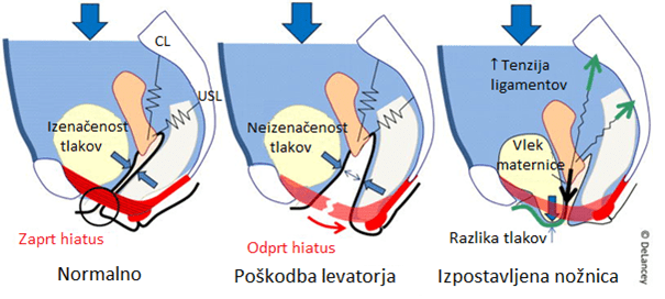 Shematski prikaz nastanka zdrsa medeničnih organov.
