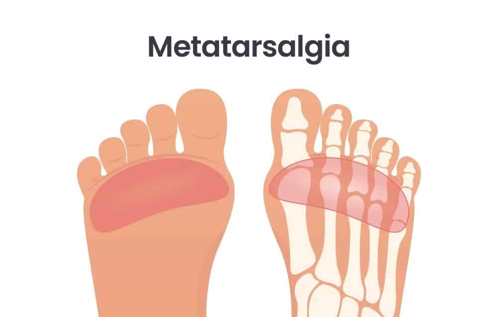 Metatarzalgija
