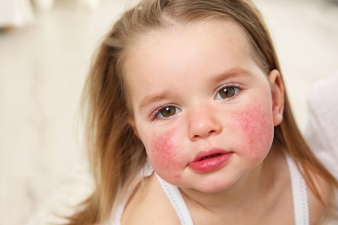 Boljši časi za obolele z atopijskim dermatitisom