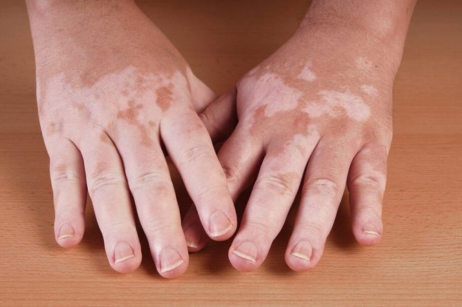 Izguba kožnega pigmenta – vitiligo