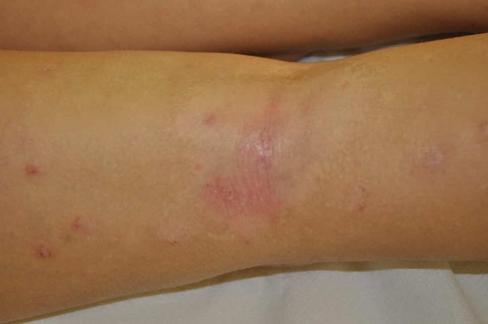 Ko otroka muči neznosna srbečica