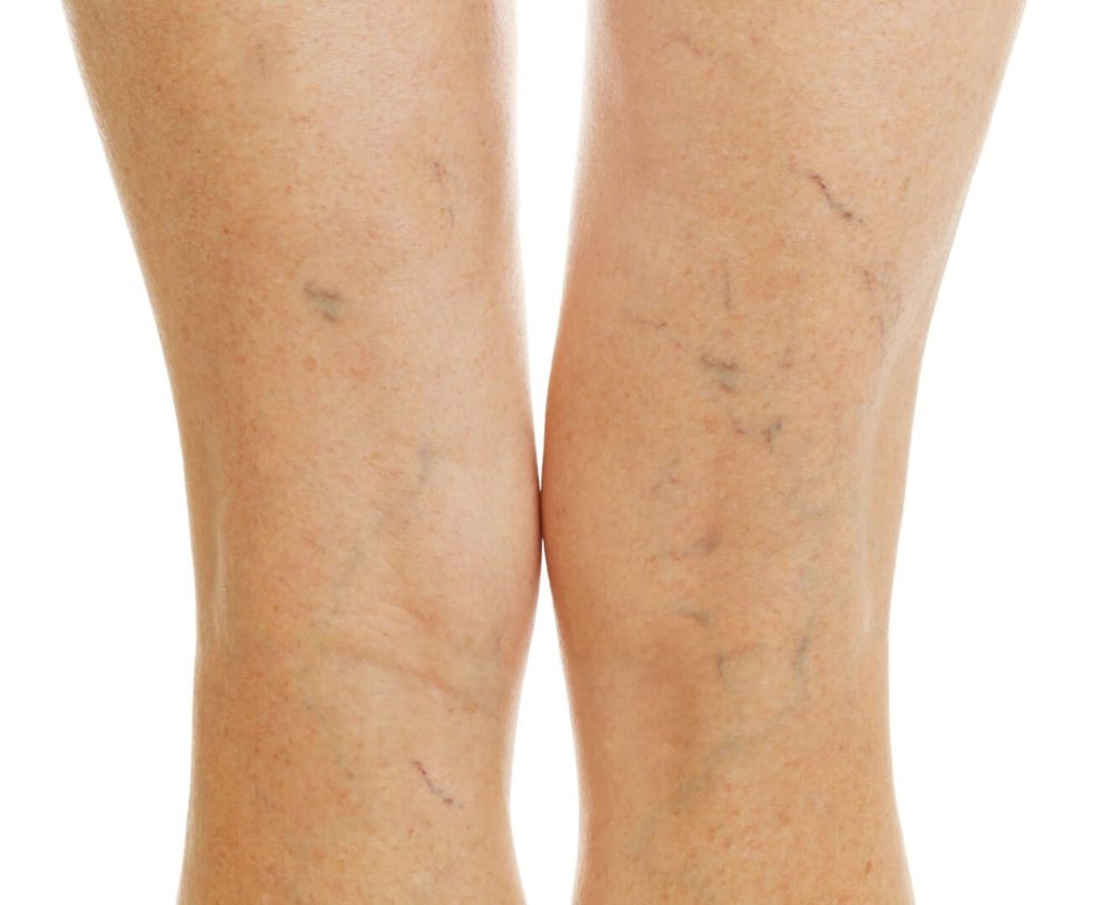 Kronična venska bolezen: Pogosta težava odraslih
