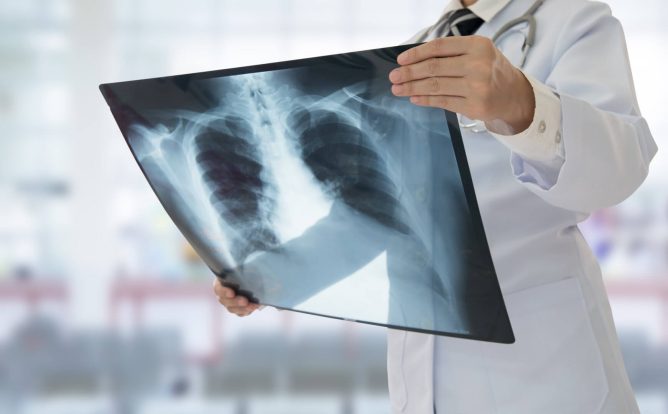 Mutacije pljučnega raka vplivajo na izbiro zdravljenja