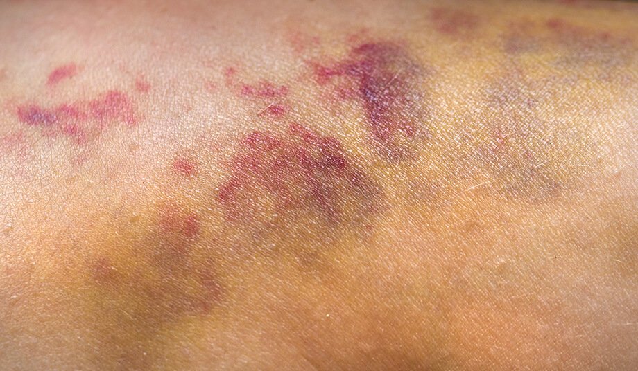 Nenadne modrice na koži: vzroki, možne bolezni in kako ukrepati