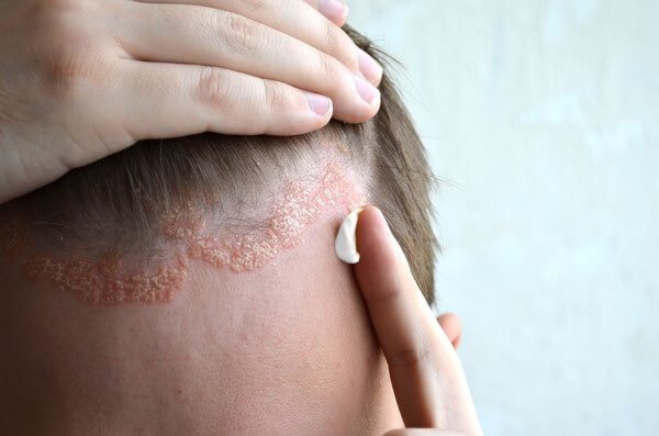 Nezdravljena luskavica – tleči plamen v telesu