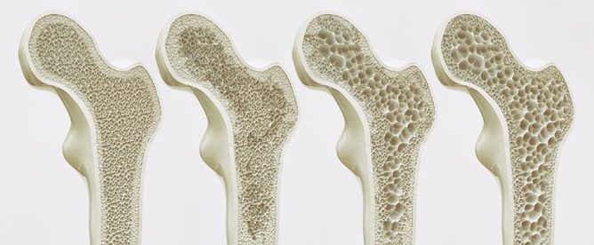 Osteoporoza ne prizanese niti otrokom