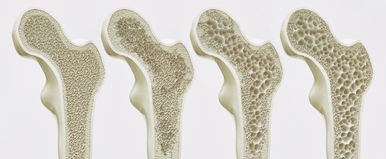 Osteoporoza ne prizanese niti otrokom