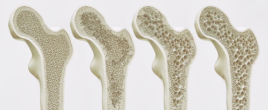 Osteoporoza ne prizanese niti otrokom