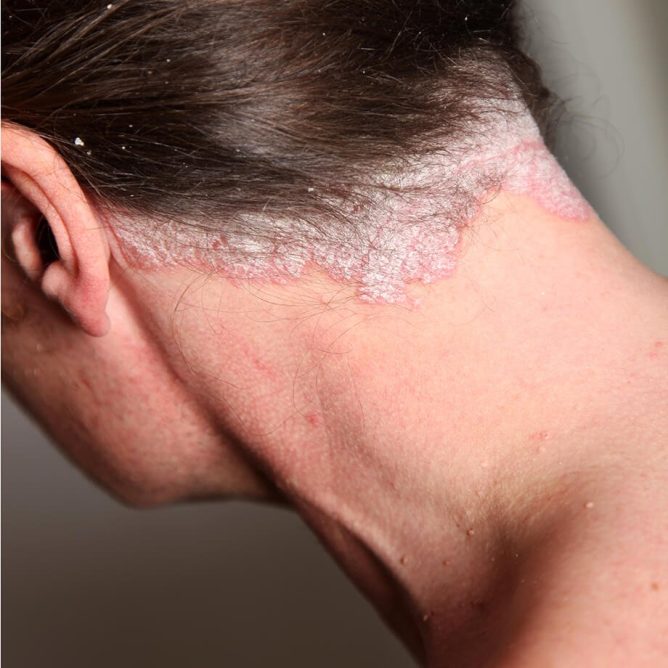 Psoriaza (luskavica): vzroki, vsakodnevno obvladovanje in zdravljenje