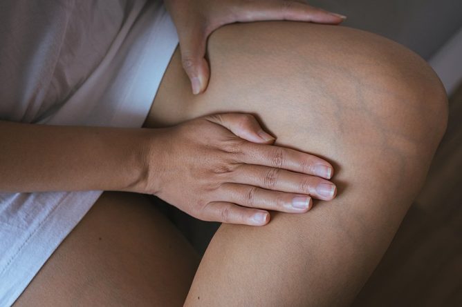 Spremembe na koži pri kronični venski bolezni