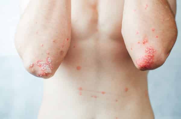 Dermatological skin disease, psoriasis, more pronounced on the elbows