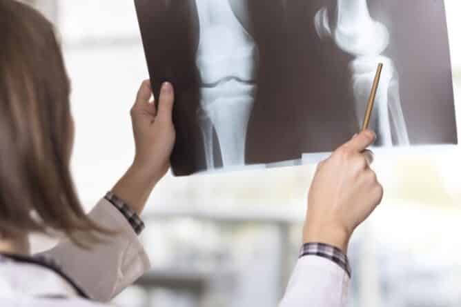 Young female doctor looking at the x-ray picture of knee injury in a hospital