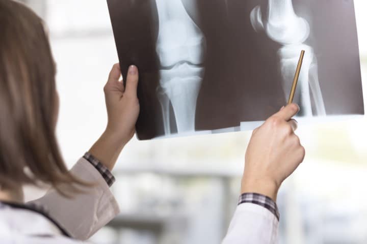 Young female doctor looking at the x-ray picture of knee injury in a hospital