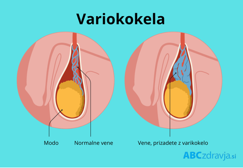 Bolečina v modih, zatrdlina v modih, neplodnost, variokokela, kaj je varikokela