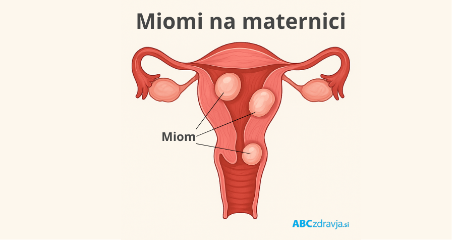 infografika z miomi na maternici, kako zgledajo miomi, kaj so miomi, miomi na maternici, maternicni miomi