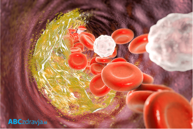 angina pektoris, kako nastane angina pektoris, ateroskleroza, simptomi angine pektoris