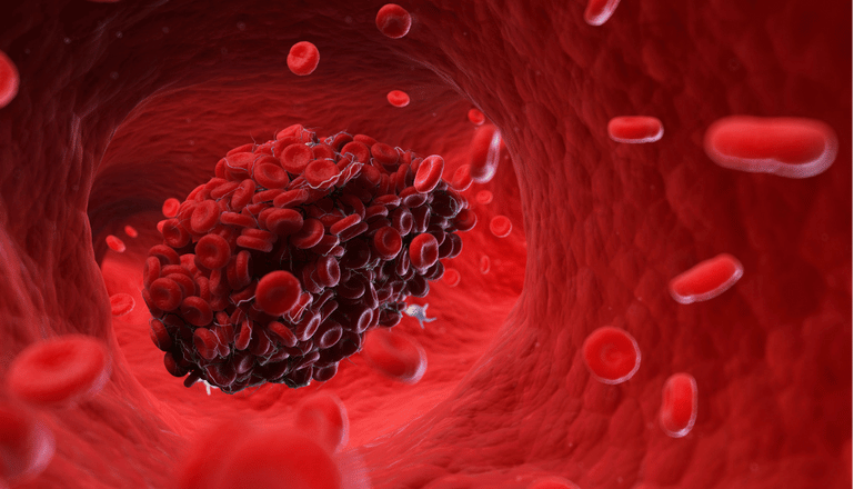 krvni strdek, kaj je krvni strdek, kako nastane krvni strdek