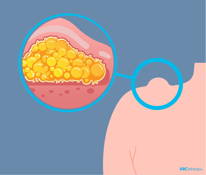 kaj je lipom, odstranitev lipoma, mehka bulica pod kožo, kožna zatrdlina