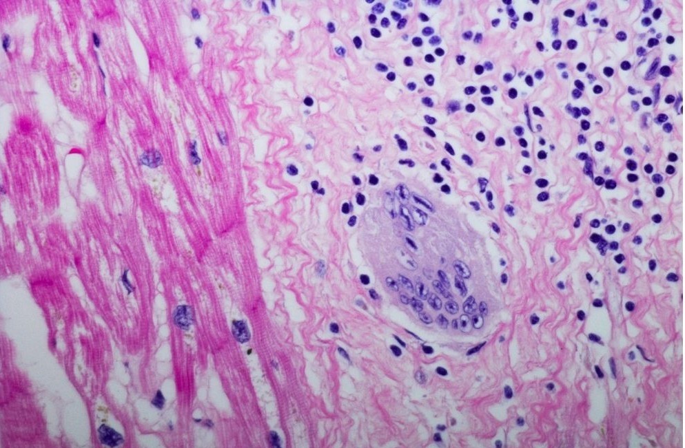Mikroskopski prikaz nekazeoznega granuloma pri sarkoidozi – okrogla skupina imunskih celic z večjedrnimi celicami v sredini in limfociti v okolici.