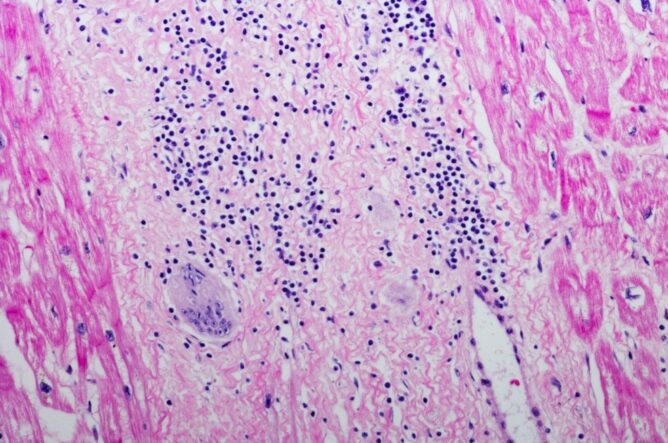 Kaj je sarkoidoza, kakšni so simptomi in kako poteka zdravljenje